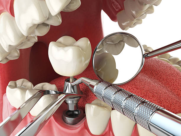 Best Emergency Root Canal Treatment in Fairfield, AL